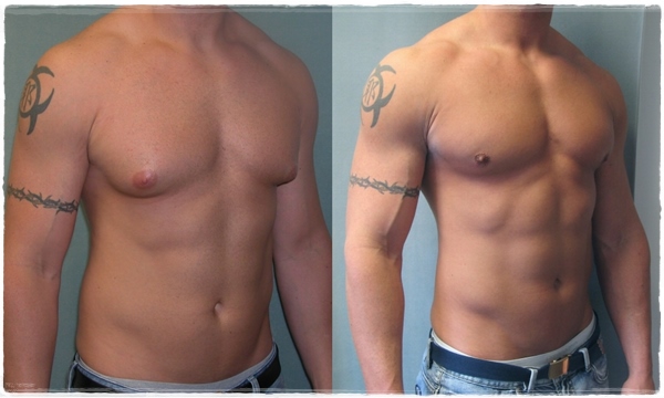 gynecomastia before and after images